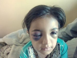 عباسپور ،ٹیچر کا پہلی کلاس کی پھول جیسی بچی پر تشدد